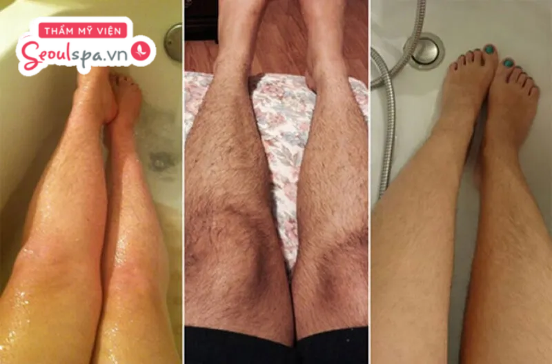 Lông chân mọc nhiều và rậm rạp bất thường có thể là dấu hiệu của bệnh lý liên quan đến sức khỏe