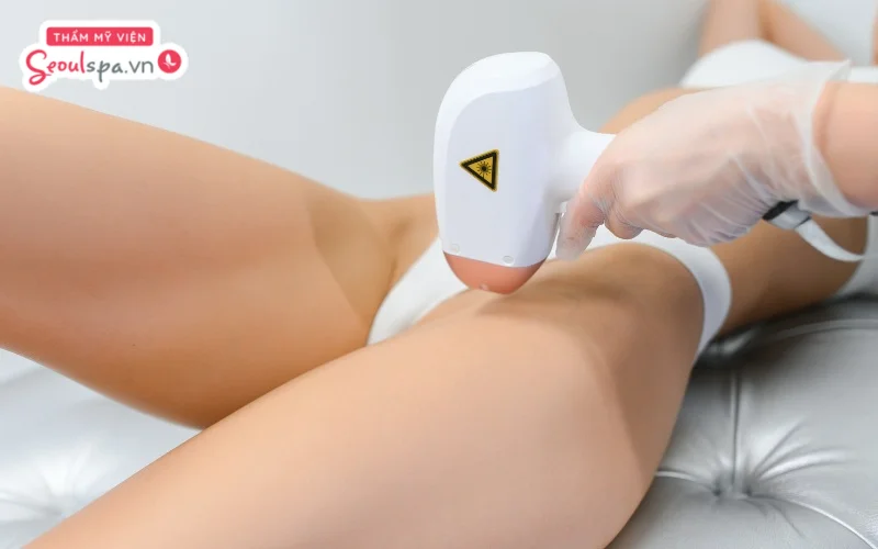 Triệt lông bằng máy Laser với xung ánh sáng phù hợp để đem lại hiệu quả ức chế sự hoạt động của nang lông