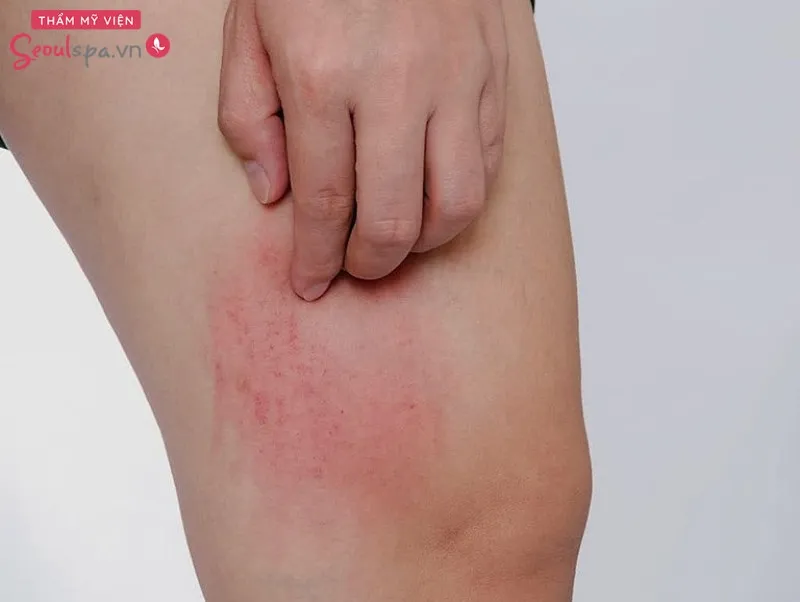 Tình trạng viêm lỗ chân lông gây nên cảm giác vô cùng ngứa ngáy, khó chịu