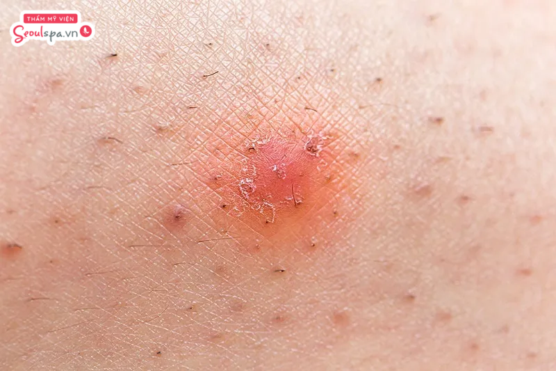 Lông vùng kín bắt đầu mọc lại sau triệt lông có thể gây ra cảm giác ngứa ngáy tạm thời trong 3 - 4 ngày