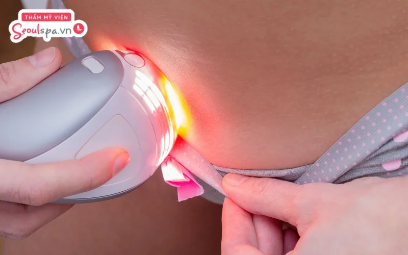 Triệt lông vùng kín là giải pháp giúp loại bỏ lông an toàn giúp vùng kín sạch sẽ, khô thoáng và phòng ngừa tối đa nguy cơ viêm nhiễm