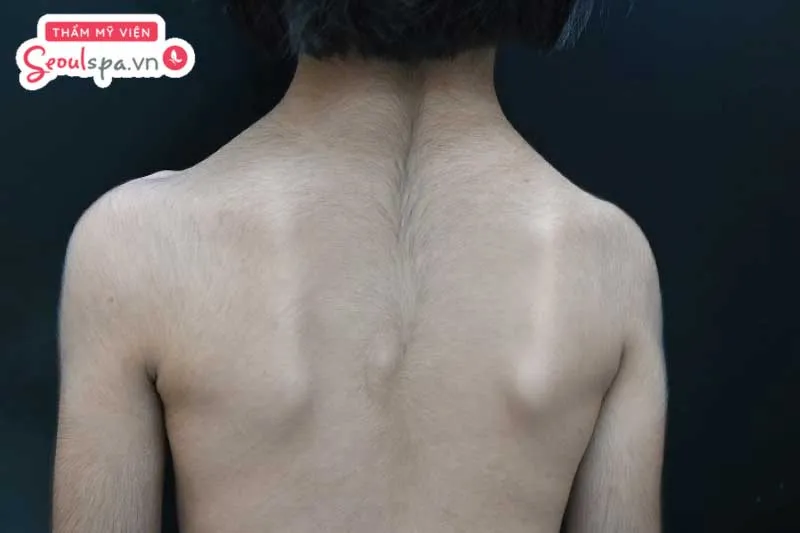 Lông mọc nhiều ở vùng lưng có thể ảnh hưởng bởi nhiều nguyên nhân khác nhau liên quan đến tính di truyền và nội tiết tố