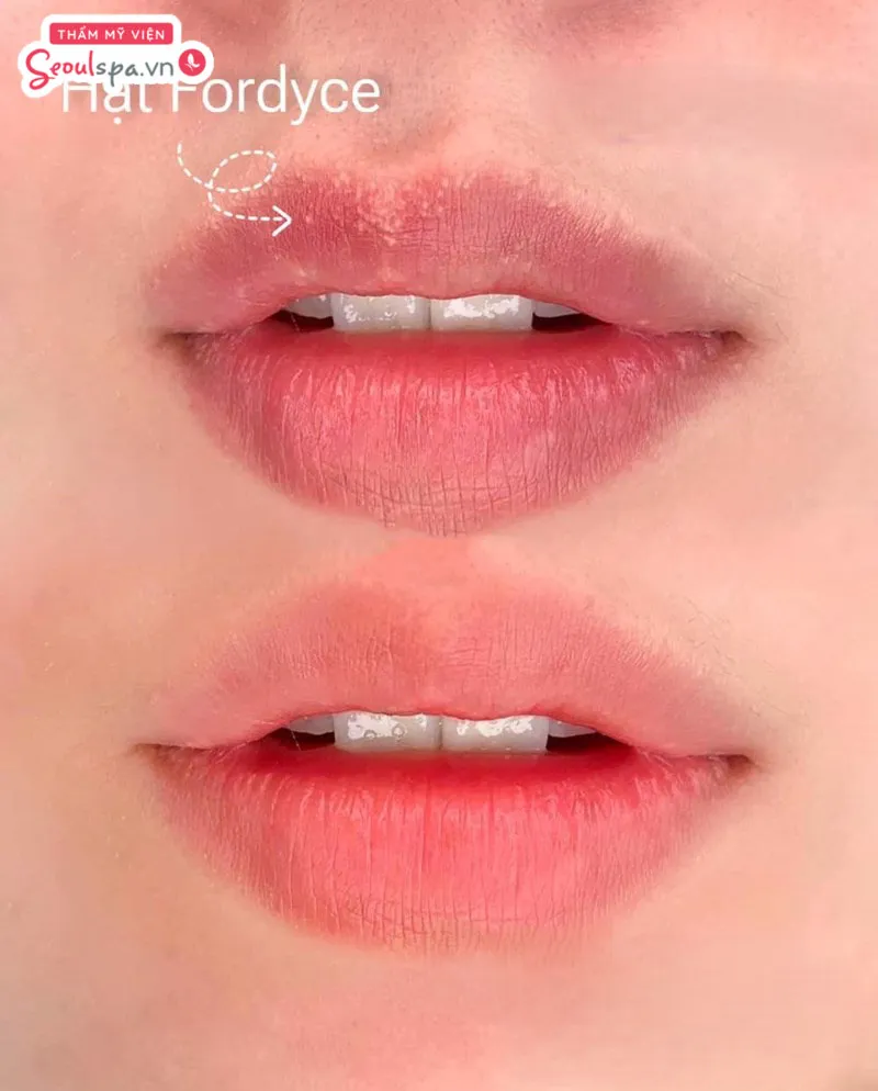 Phun môi giúp cải thiện tình trạng hạt Fordyce li ti trên môi và thúc đẩy quá trình tái tạo tế bào da mới