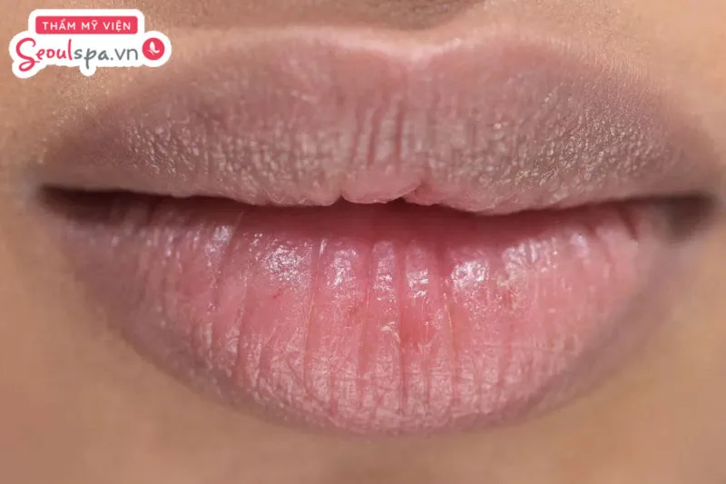 Người có môi thâm, viền môi thâm kém sắc có thể thực hiện phun xăm thẩm mỹ để cải thiện sắc tố môi
