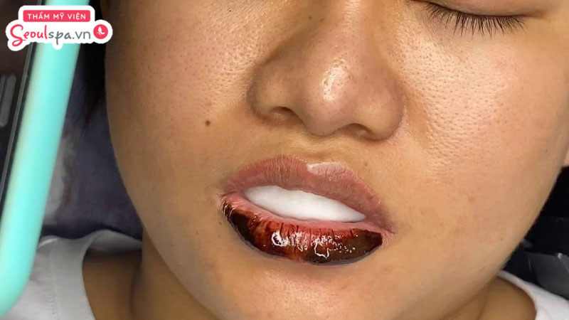 Sử dụng dung dịch đào thải mực xăm là cách giúp loại bỏ mực xăm dưới môi và cải thiện đốm đen trên môi hiệu quả