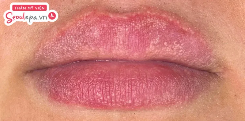 Phun môi nổi mụn trắng li ti là một trong những tình trạng phun môi bị hỏng và tiềm ẩn nhiều nguy cơ viêm nhiễm