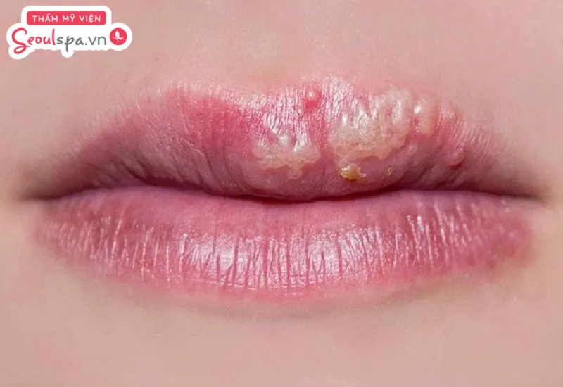 Phun môi nổi mụn trắng nếu không điều trị đúng cách kịp thời có thể tiềm ẩn nguy cơ áp xe, nhiễm trùng và hoại tử mô