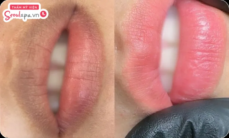 Tùy vào tình trạng thâm xỉn môi của từng người mà chuyên viên sẽ cân nhắc có nên thực hiện khử thâm trước phun môi không