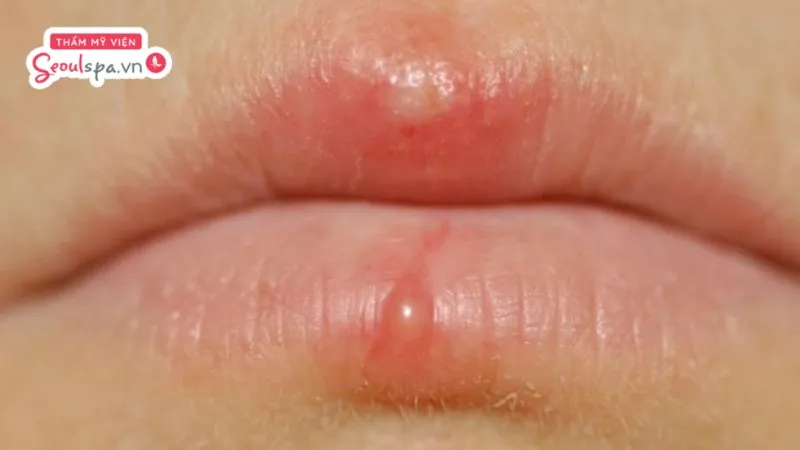 Thực hiện phun môi Collagen sai cách có thể tiềm ẩn nhiều nguy cơ nhiễm trùng và mưng mủ