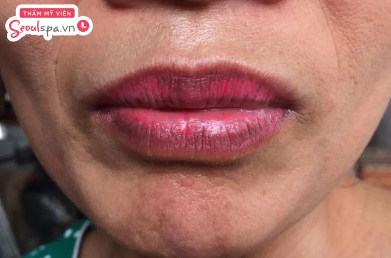 Một trong những biến chứng khi thực hiện phun môi Collagen với mực xăm chất lượng là khiến môi lên màu đậm và khó chỉnh sửa