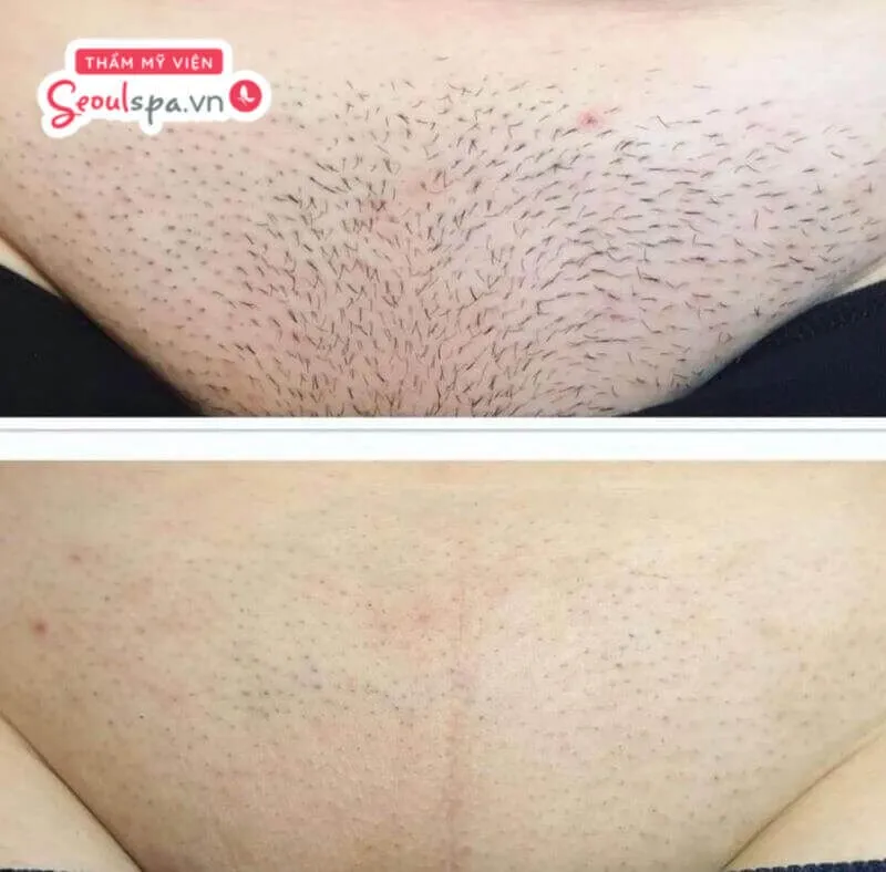 Chế độ bảo hành thẩm mỹ của từng địa chỉ được cho là yếu tố ảnh hưởng trực tiếp đến giá triệt lông