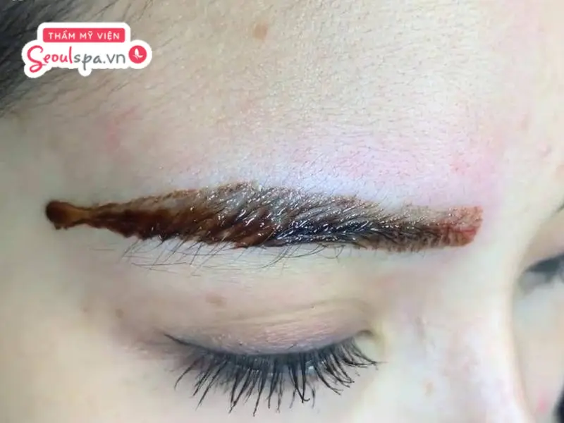 Hút mực xăm chân mày bằng dung dịch là phương pháp phổ biến để loại bỏ mực xăm dưới da hiệu quả