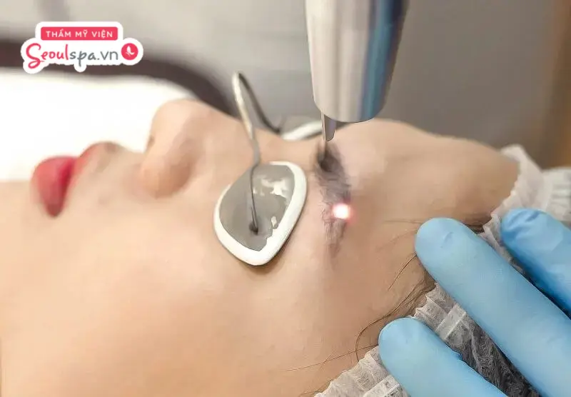Xóa xăm lông mày IPL sử dụng chùm ánh sáng cường độ cao để phá vỡ cấu trúc hạt mực dưới da