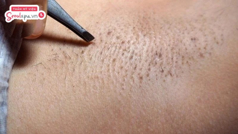 Vùng nách sần sùi sau khi nhổ lông thường do nang lông bị tổn thương trong quá trình cạo nhổ liên tục