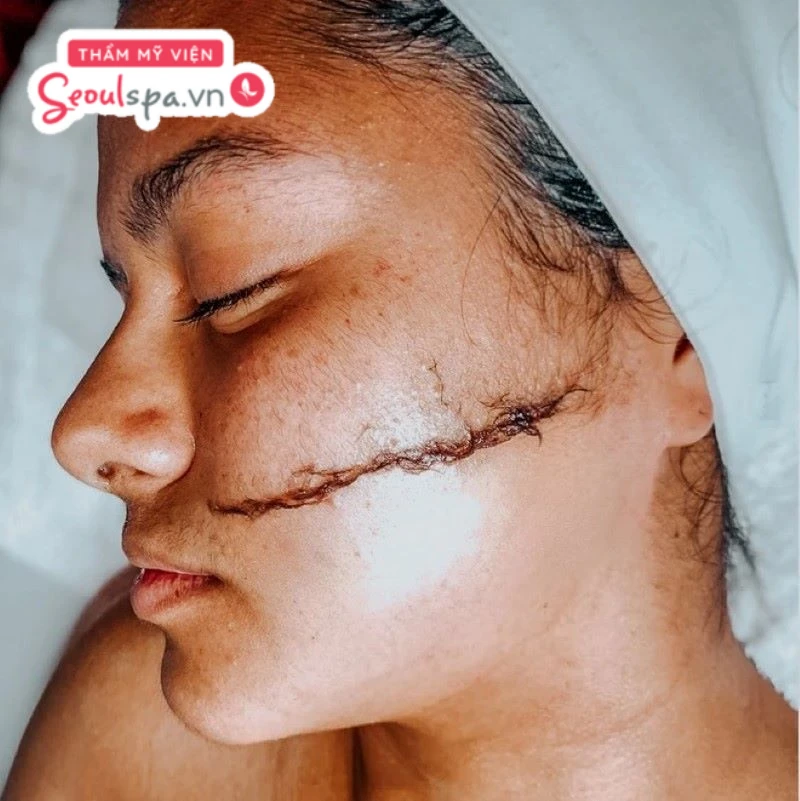 Triệt lông mặt giúp bề mặt da thông thoáng hơn và gia tăng hiệu quả hấp thụ dưỡng chất từ sâu bên trong