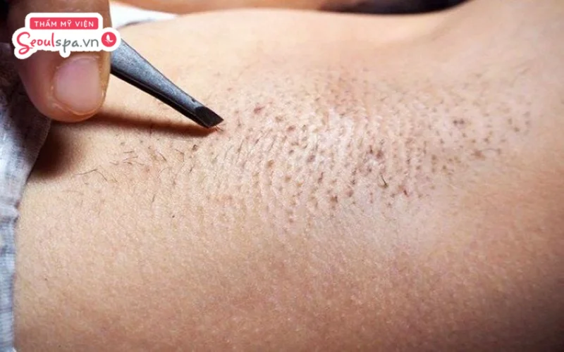 Quá trình nhổ lông nách nếu thực hiện liên tục có thể khiến nách sần sùi và kém mịn màng