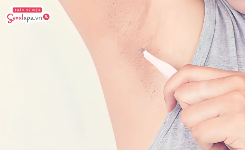 Thao tác nhổ lông nách bằng nhíp để loại bỏ từng sợi lông khỏi bề mặt da thường dễ gây đau rát, rướm máu
