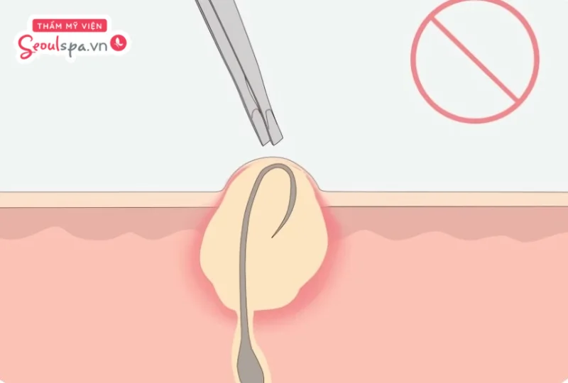 Việc nhổ lông nách sai cách có thể khiến bụi bẩn tích tụ ở lỗ chân lông và gia tăng nguy cơ lông mọc ngược