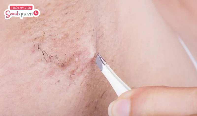 Thao tác thực hiện nhổ lông với lực kéo mạnh có thể khiến lỗ chân lông giãn nở và ngày càng to hơn