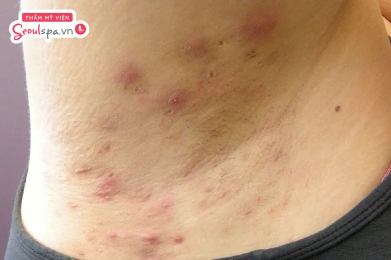 Không chăm sóc da sạch sẽ sau khi nhổ lông nách có thể khiến nách dễ tích tụ bụi bẩn và hình thành mụn gây viêm nang lông