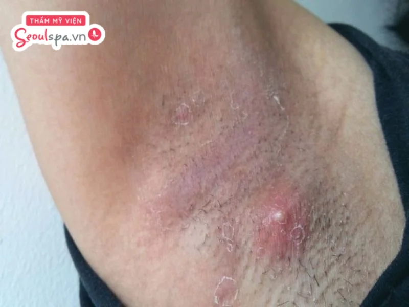 Nhổ lông nách sai cách liên tục có thể gia tăng nguy cơ viêm mãn tính và rối loạn mô vùng ngực