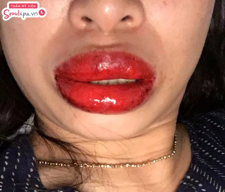 Môi sưng sau phun môi là dấu hiệu phun môi bị hỏng