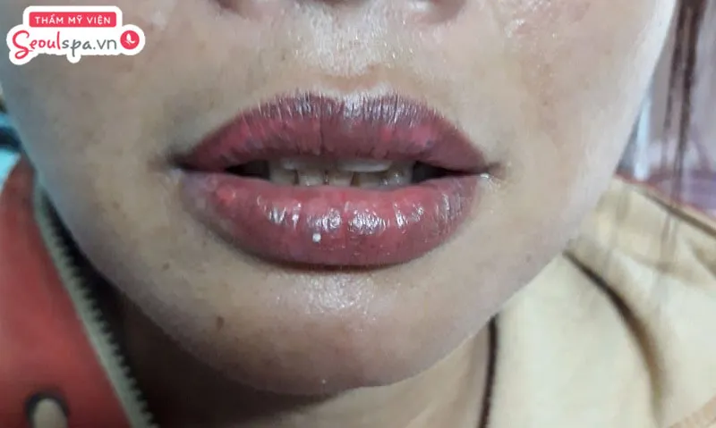 Môi bị bầm tím nặng sau phun kéo dài là dấu hiệu cho biết phun môi hỏng