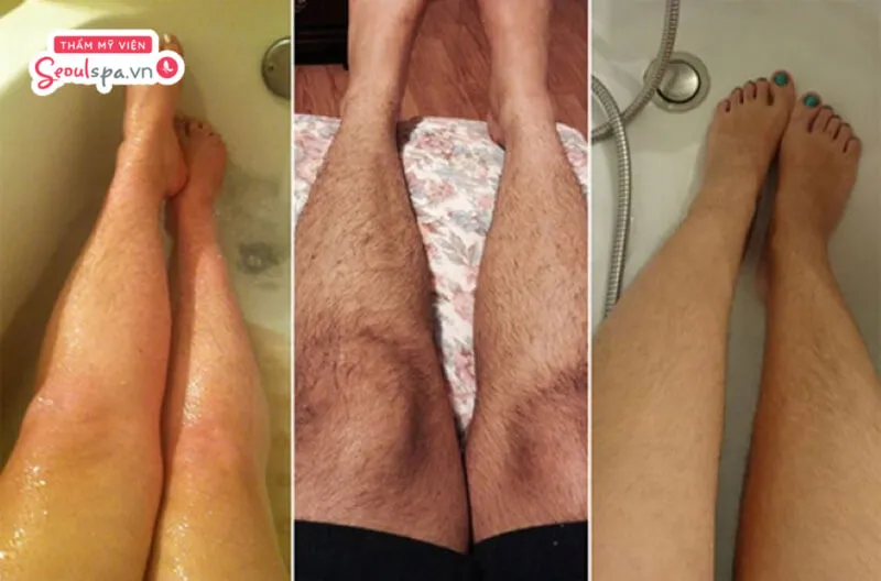 Lông chân mọc nhiều và rậm rạp bất thường có thể là dấu hiệu của bệnh lý liên quan đến sức khỏe