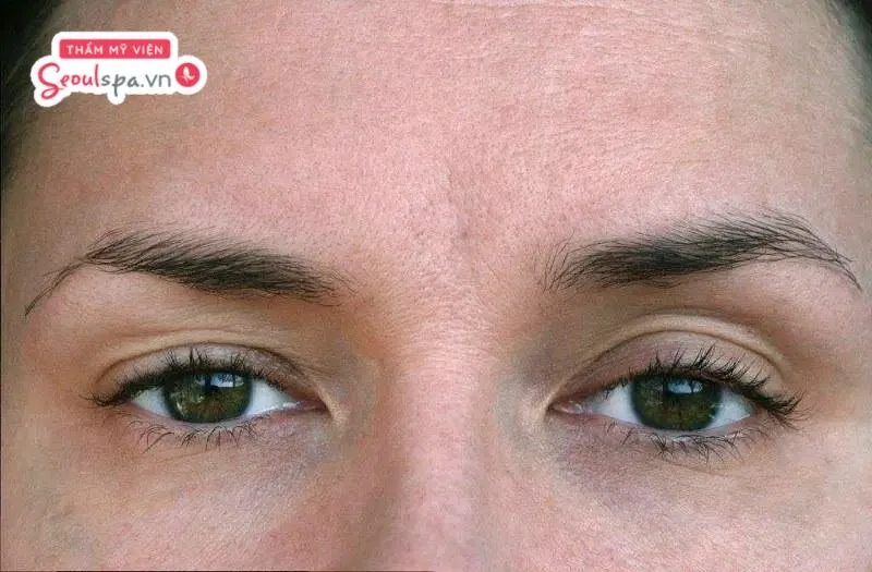 Phun mí mắt có thể giúp cải thiện tình trạng mí mắt bị sụp nhẹ mà không cần can thiệp phẫu thuật