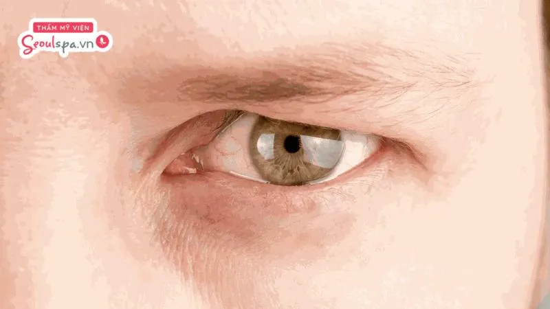 Tình trạng mí mắt bị sụp nặng và che khuất tầm nhìn mắt thường không nên khắc phục bằng phun xăm thẩm mỹ