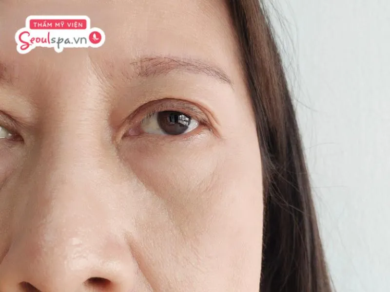 Tình trạng mí mắt bị sụp nặng và che khuất tầm nhìn mắt thường không nên khắc phục bằng phun xăm thẩm mỹ