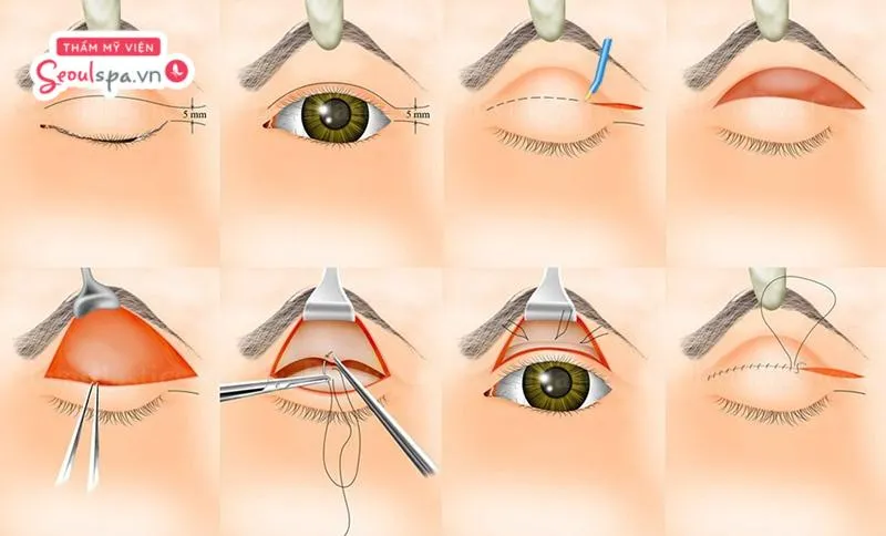 Tùy vào tình trạng sụp mí mắt của từng người mà chuyên gia có thể can thiệp phương pháp khắc phục phù hợp