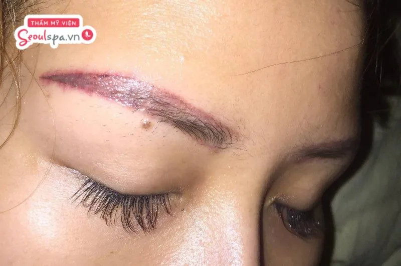 Phun lông mày bị trổ đỏ là dấu hiệu phun xăm bị hỏng khiến màu chân mày trổ màu gây mất thẩm mỹ