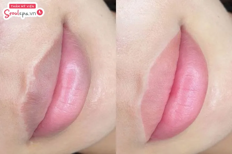 Thực hiện khử thâm môi lần 2 là cách xử lý khi phun môi không đều màu và mực xăm lên màu không chuẩn