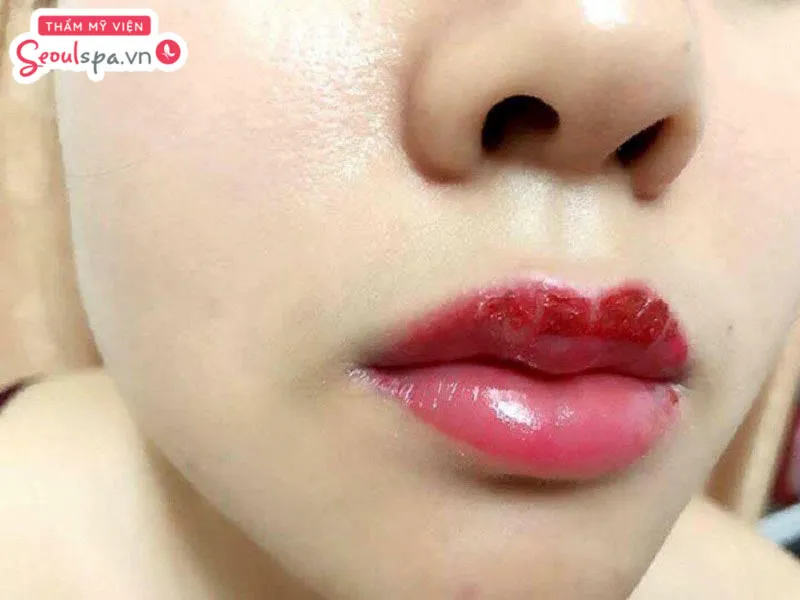 Phun môi nhiều lần có sao không? Việc phun môi quá nhiều lần có thể khiến môi trở nên kém tự nhiên và ảnh hưởng thẩm mỹ