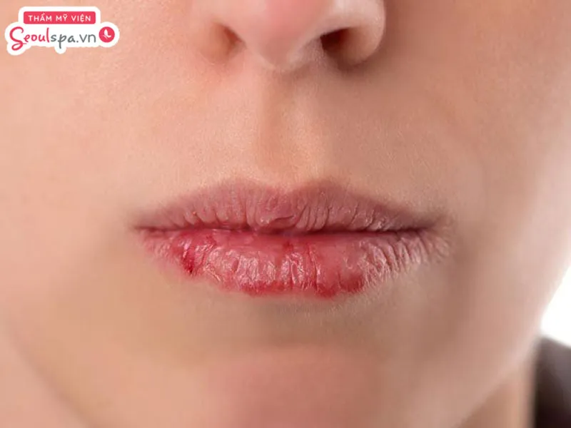 Hình ảnh môi khô và có dấu hiệu viêm đỏ, nứt nẻ và chảy máu