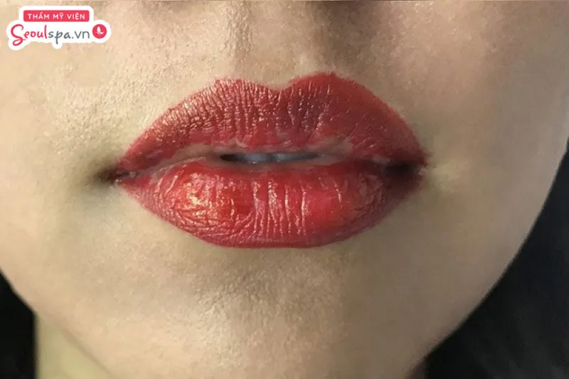 Môi có dấu hiệu loang lổ, khô nứt gây ảnh hưởng đến tính thẩm mỹ môi sau phun