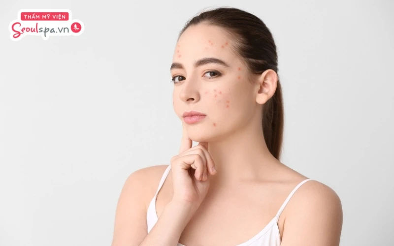 Triệt lông mặt nổi mụn là tình trạng thường gặp khi không chăm sóc da đúng cách sau triệt