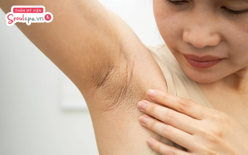 Nhổ lông nách có thể tiềm ẩn nguy cơ viêm nang lông khiến da sần sùi và thâm sạm gây mất thẩm mỹ