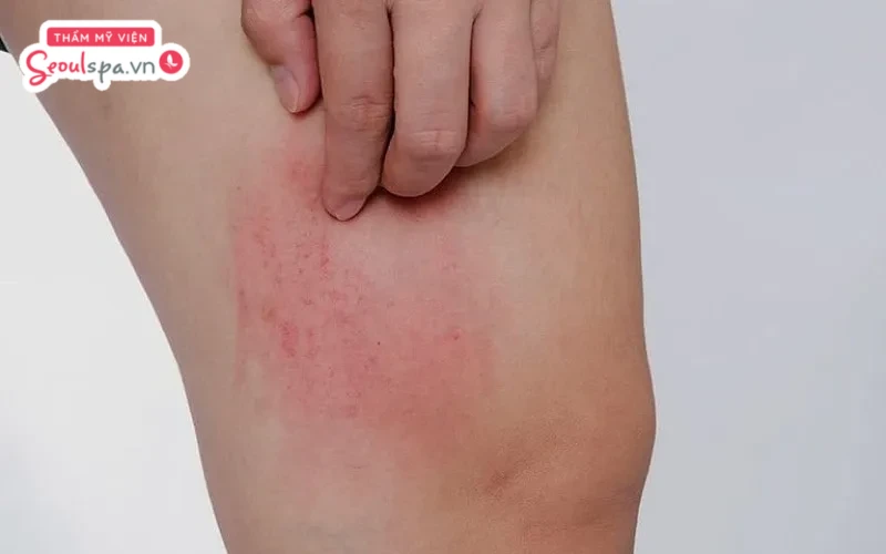 Tình trạng viêm lỗ chân lông gây nên cảm giác vô cùng ngứa ngáy, khó chịu