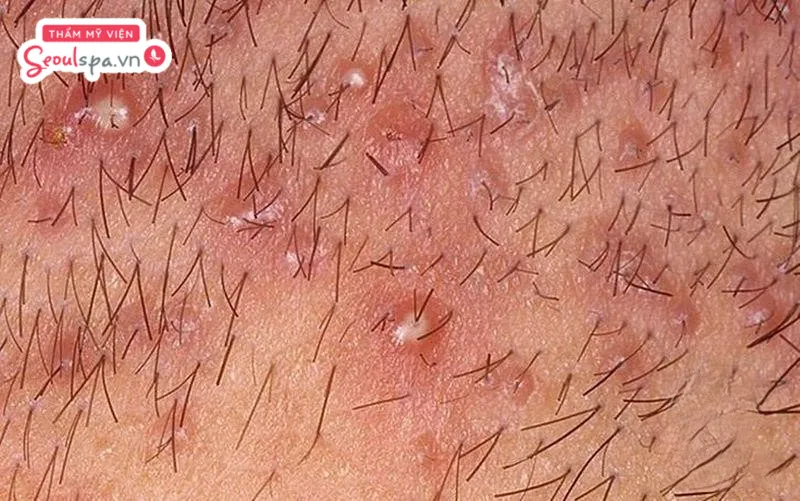 Triệt lông bikini về bị ngứa kéo dài có thể tiềm ẩn nguy cơ viêm nang lông nếu không xử lý đúng cách