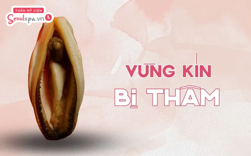 Thực hiện triệt lông sai cách khiến bề mặt da bị tổn thương là nguyên nhân phổ biến khiến triệt lông bikini bị thâm