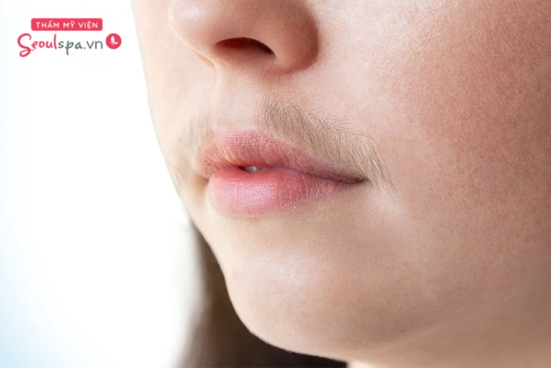 Tùy vào vị trí mọc lông mà chuyên gia sẽ xác định số buổi triệt lông phù hợp để đạt được hiệu quả rõ rệt