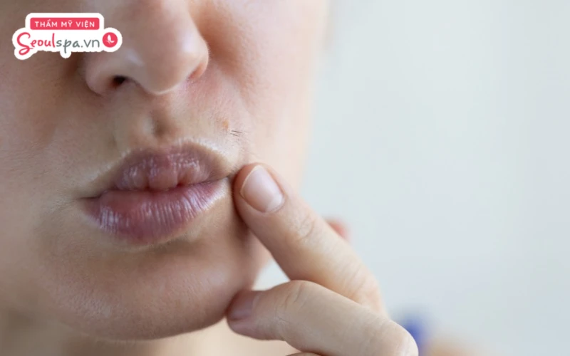 Người có làn da nhạy cảm, dễ kích ứng cần sử dụng các công nghệ triệt hiện đại có tích hợp đầu làm lạnh nên chi phí thực hiện sẽ cao hơn