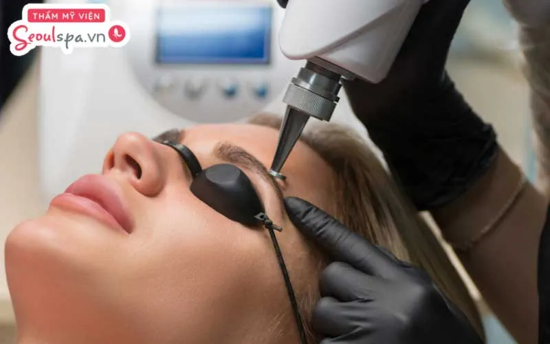 Triệt lông chân mày là phương pháp loại bỏ lông mày mọc thừa giúp chân mày trở nên sắc nét hơn