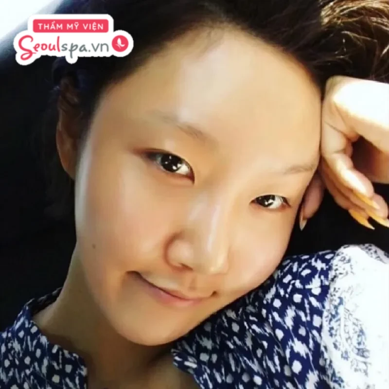 Lông mày nhạt màu, mờ và không rõ nét là một trong những đặc điểm khiến khuôn mặt nhợt nhạt và nên cân nhắc triệt lông mày