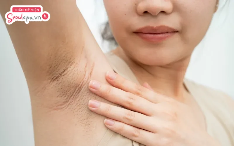Không thực hiện tẩy tế bào chết vùng da dưới cánh tay định kỳ có thể khiến da chết tích tụ và gây thâm nách