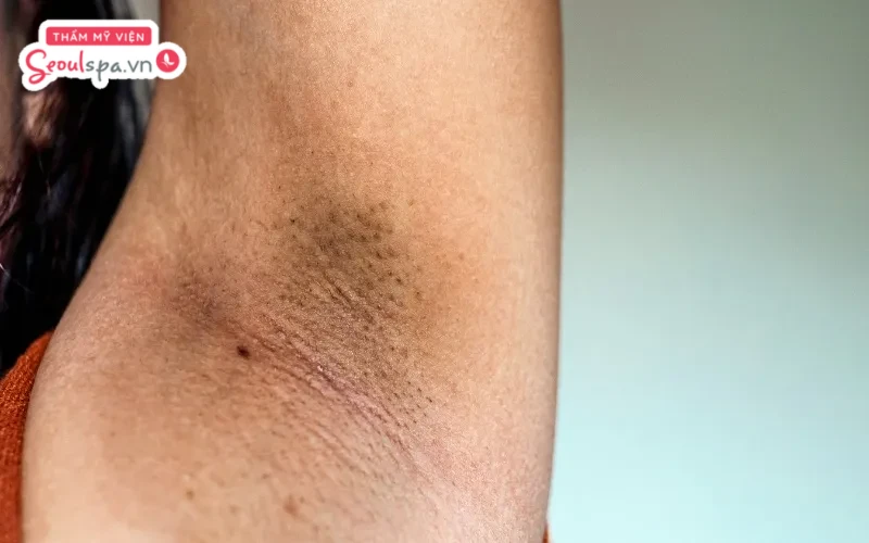 Nách thâm đen và tối màu đột ngột có thể là trường hợp hy hữu cảnh báo dấu hiệu ung thư