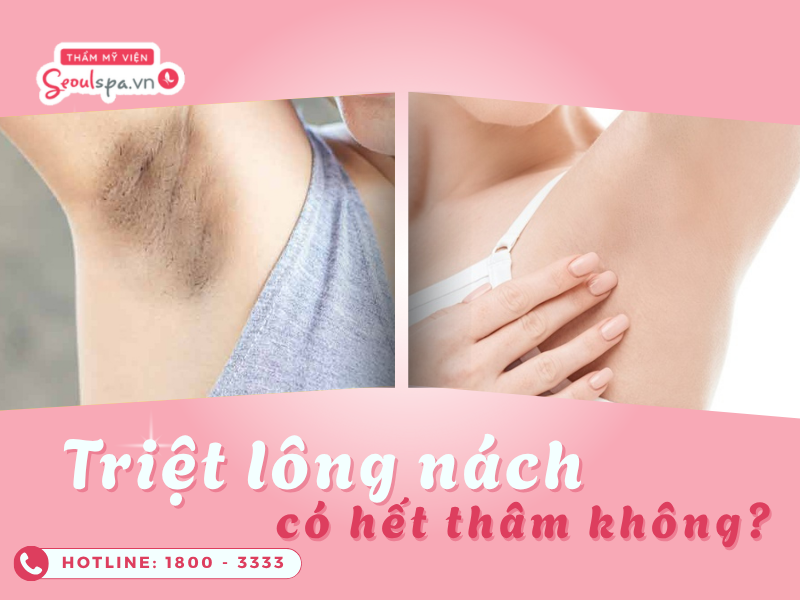 Triệt lông nách có hết thâm không