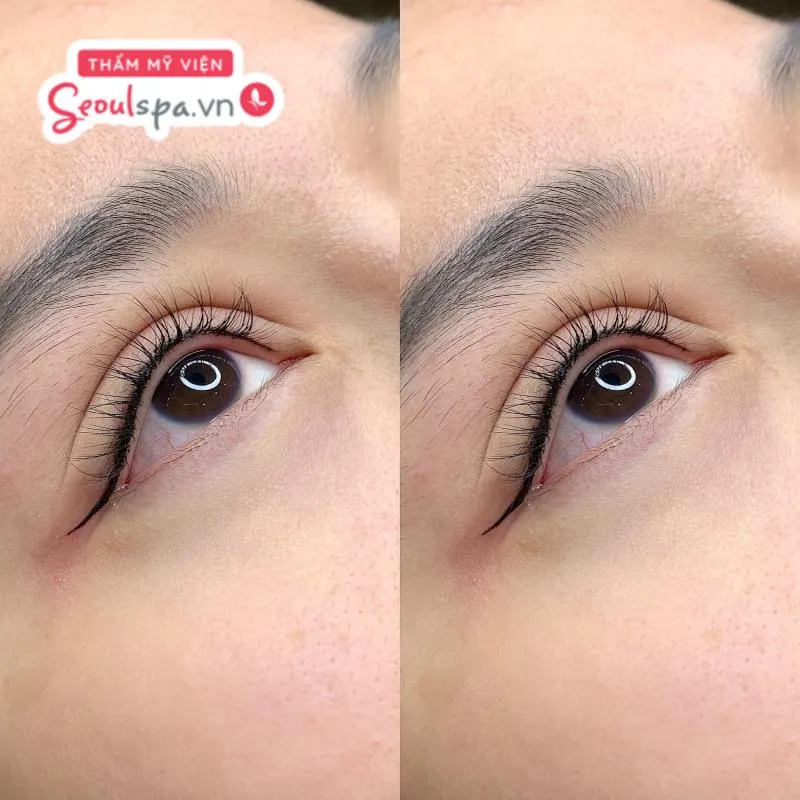 Phun mí mắt trên là phương pháp giúp khắc phục khuyết điểm đường mí mờ nhạt và giúp cải thiện tình trạng mắt nhỏ